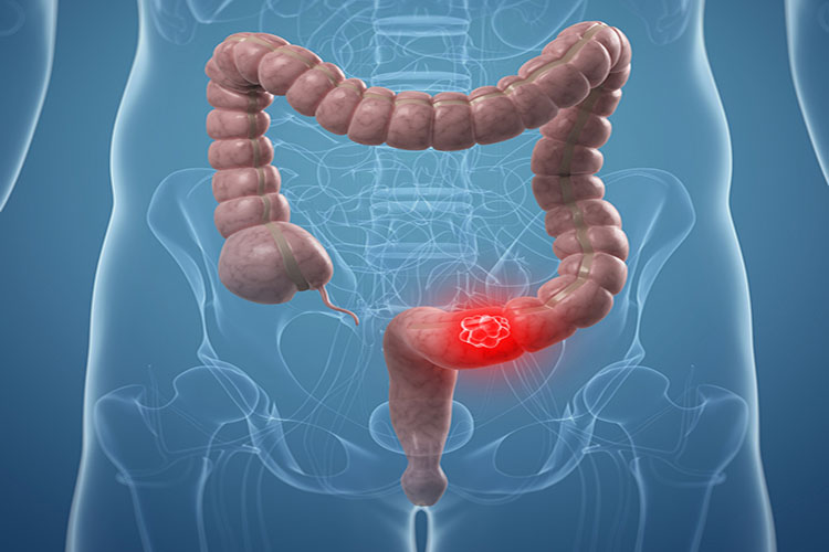 Colon cancer