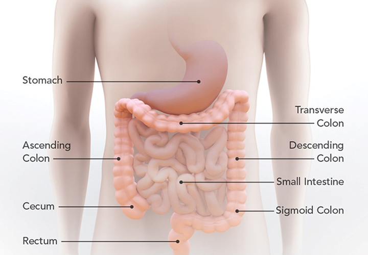 Colon cancer