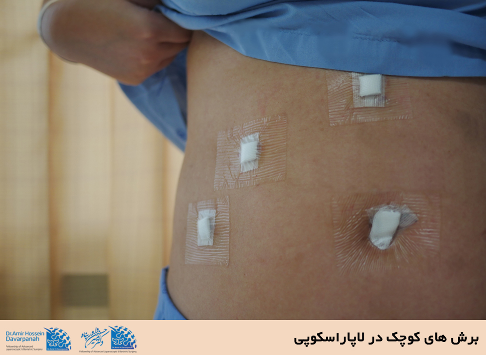 در جراحی لاپاراسکوپی