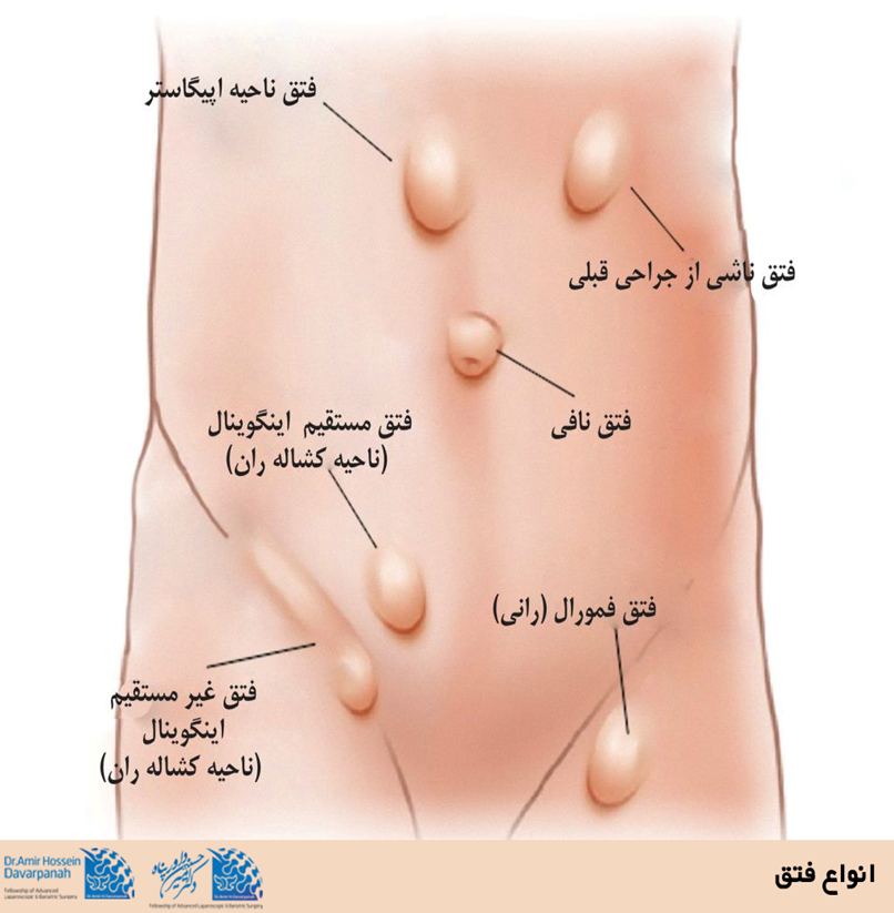 شایع¬ترین انواع فتق