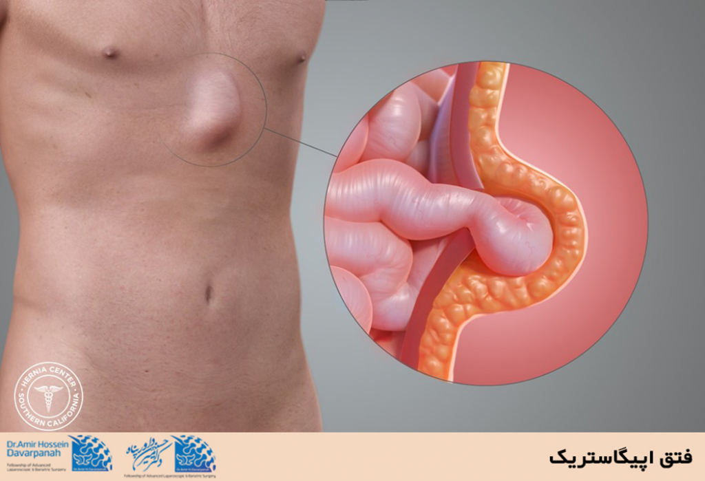 فتق اپیگاستریک
