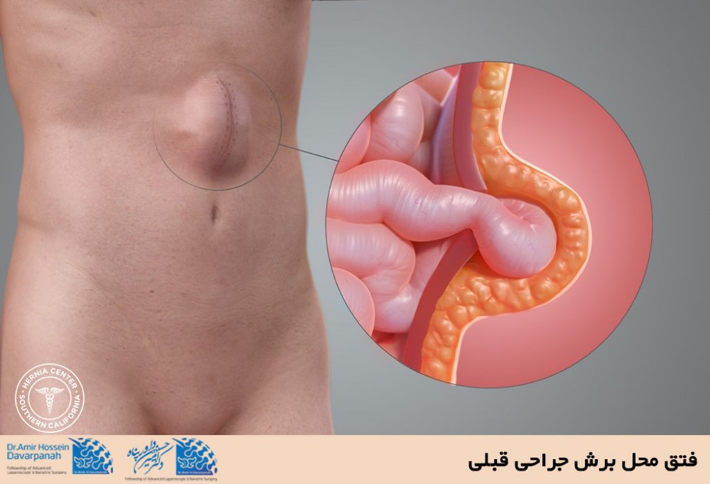 فتق محل برش جراحی قبلی