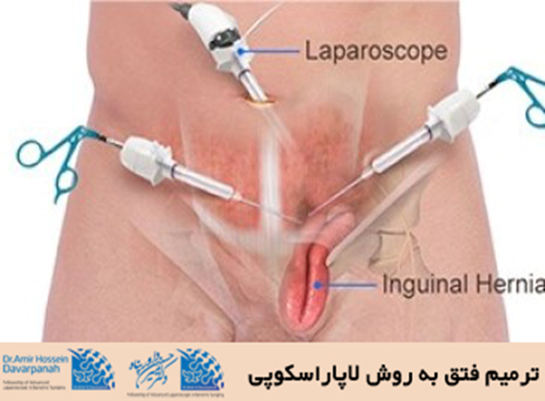 ، جراحی ترمیم فتق 
