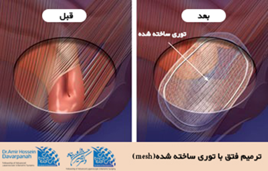 ترمیم فتق با استفاده از توری ساخته شده 