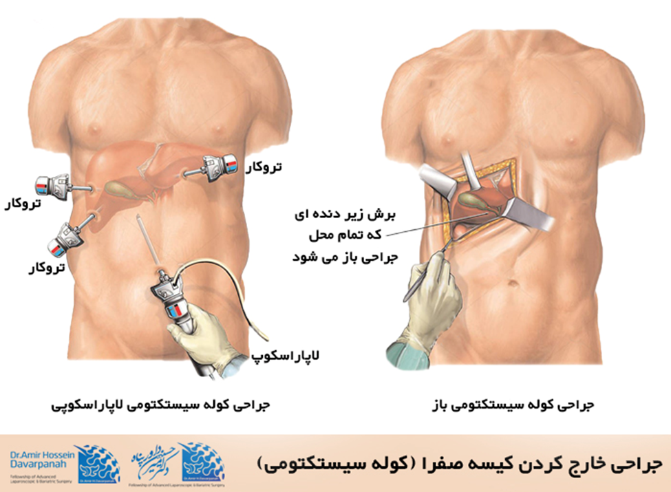 خارج کردن کیسه صفرا