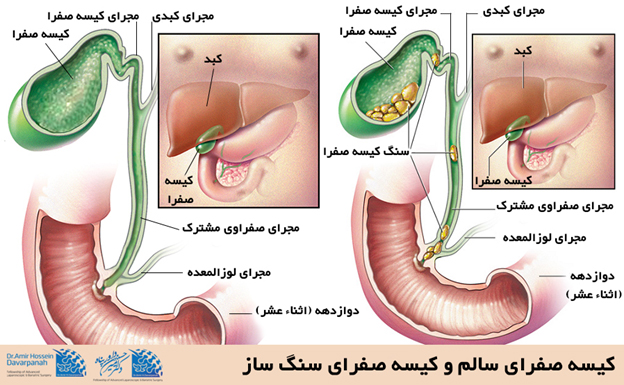 سنگ کیسه صفرا
