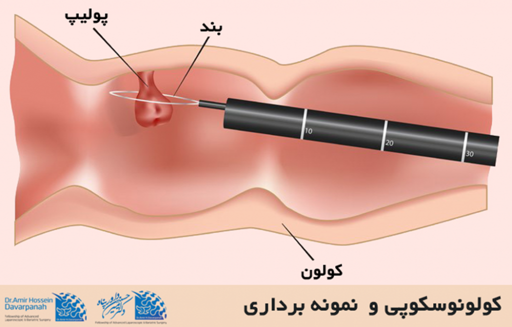 نمونه¬برداری تشخیص سرطان کولون 